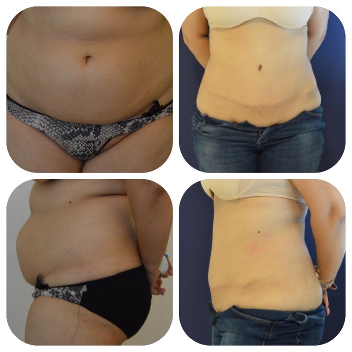 Vaser Liposuktion