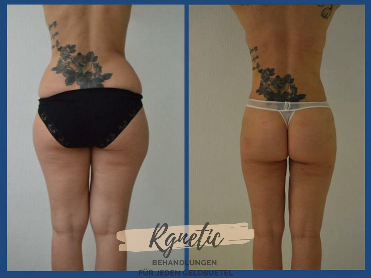 Vaser Liposuktion