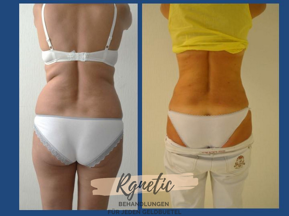 Vaser Liposuktion