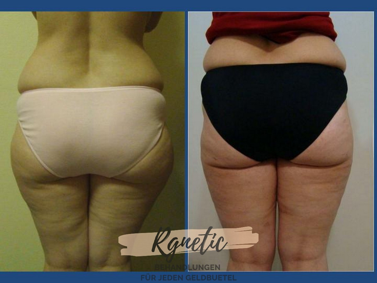 Bodyshape Vaser Fettabsaugung