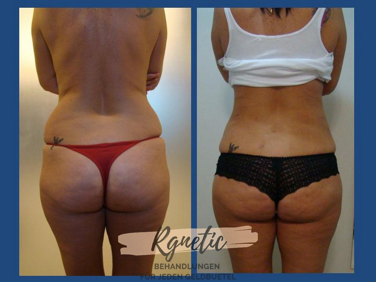 Bodyshape Vaser Fettabsaugung