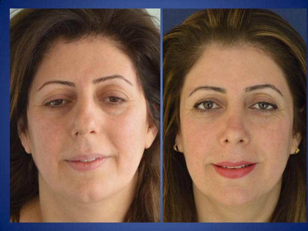 Facelifting