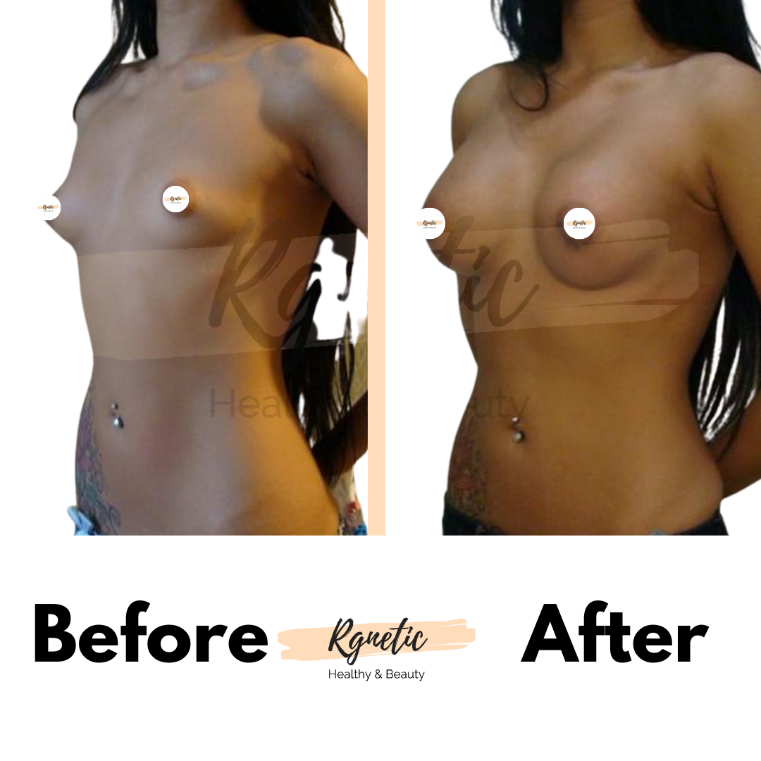 Breast lift
