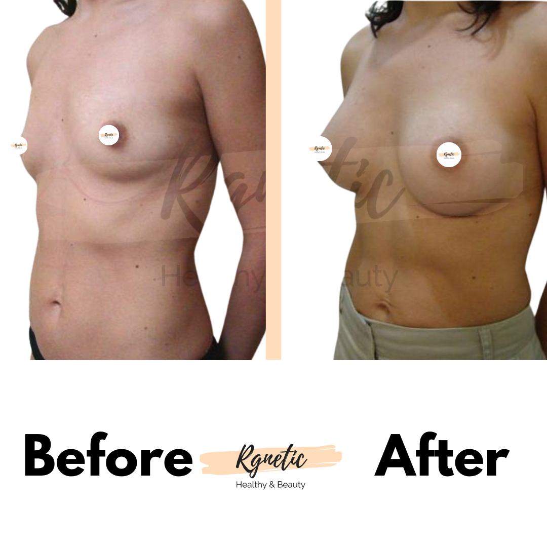 Breast lift