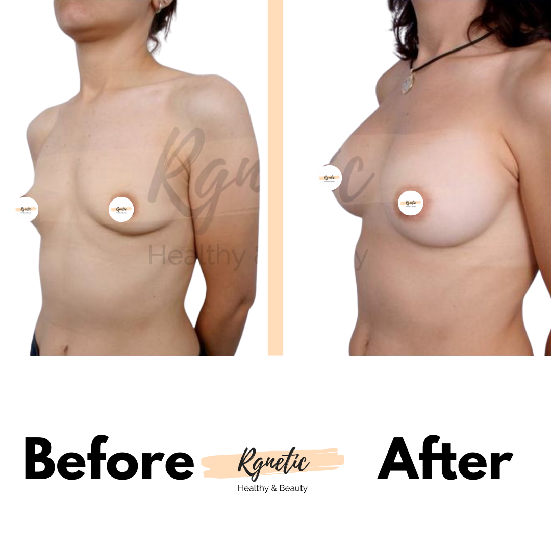 Breast lift