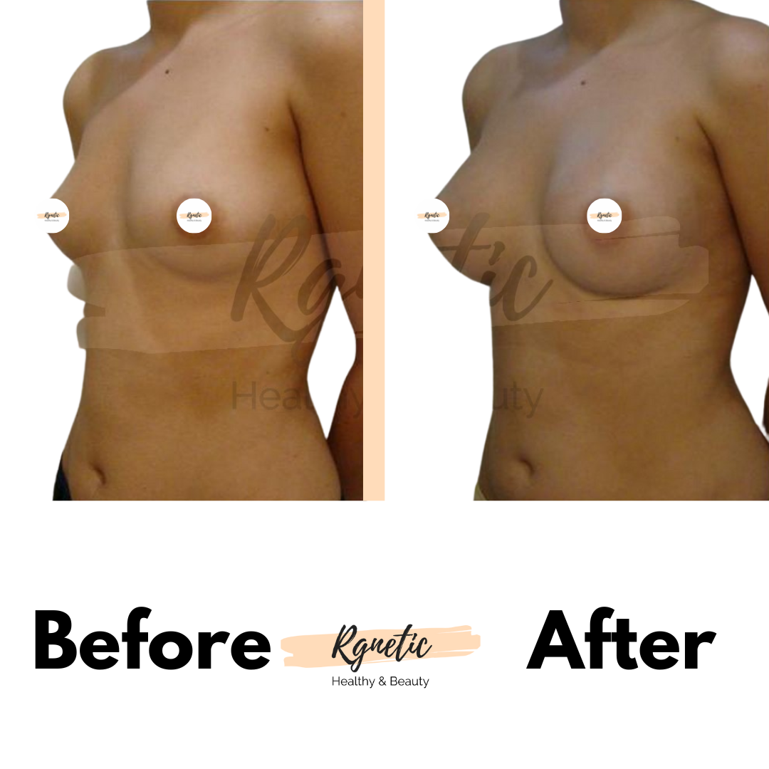 Breast lift