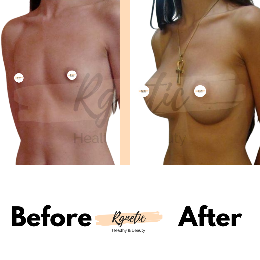 Breast lift