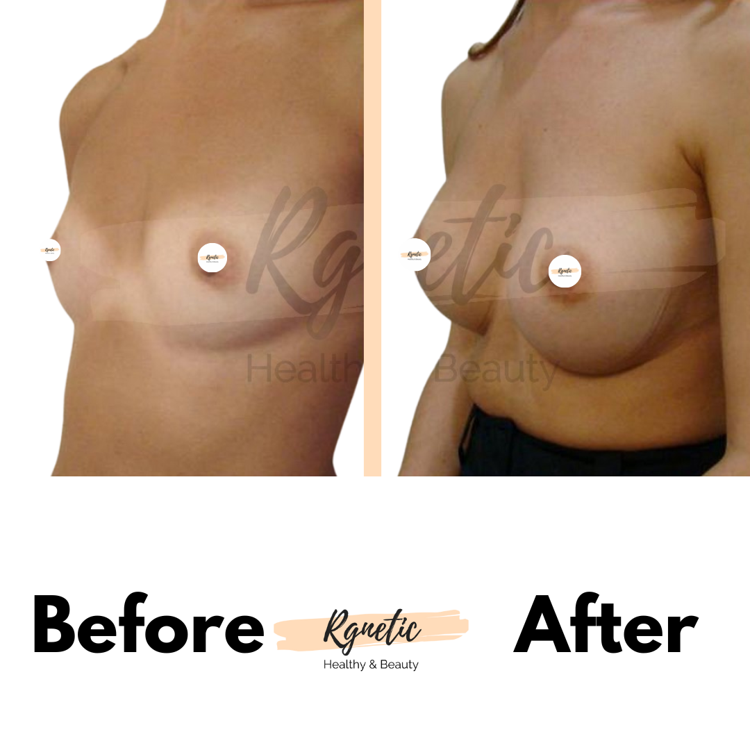 Breast lift