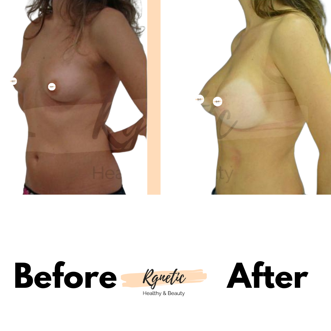 Breast lift
