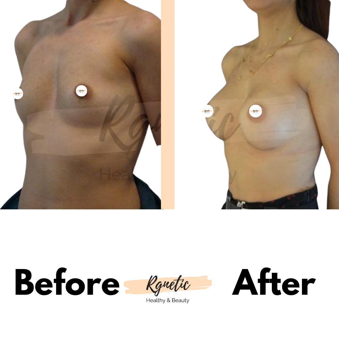 Breast lift