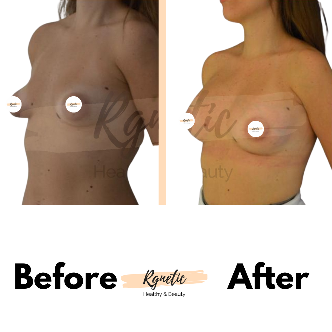 Breast lift