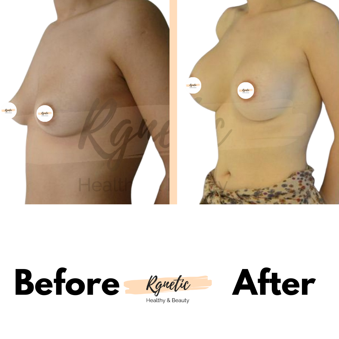 Breast lift