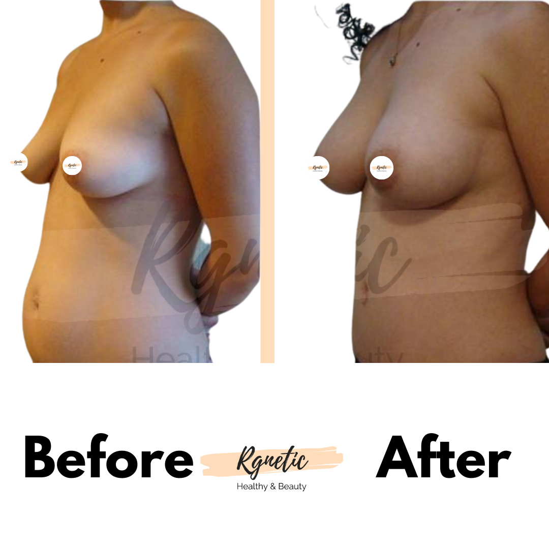 Breast lift