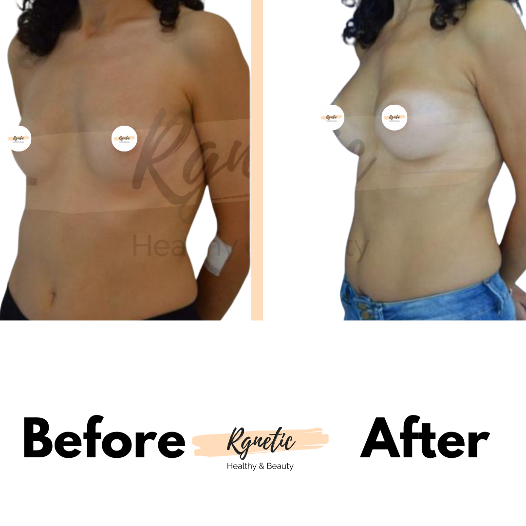 Breast Lift