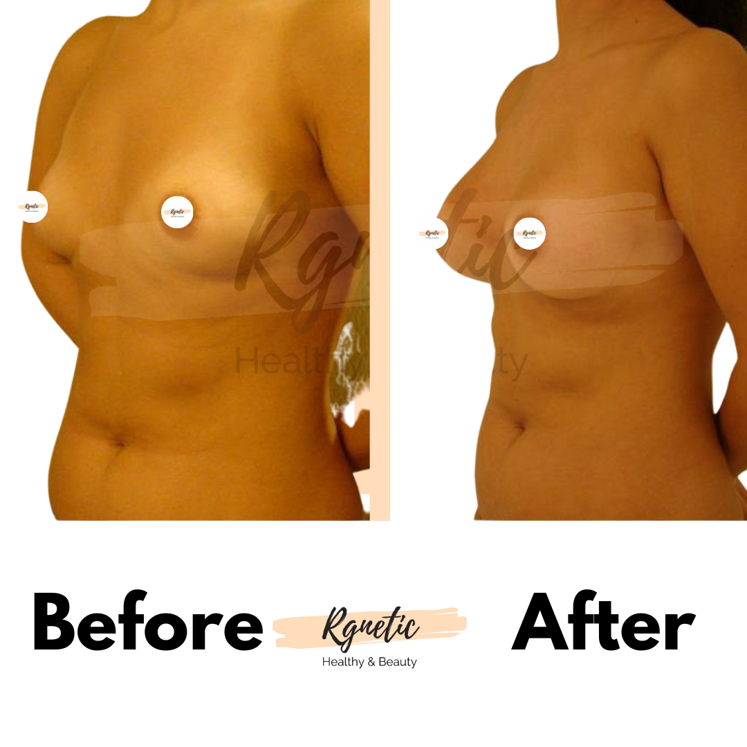 Breast lift
