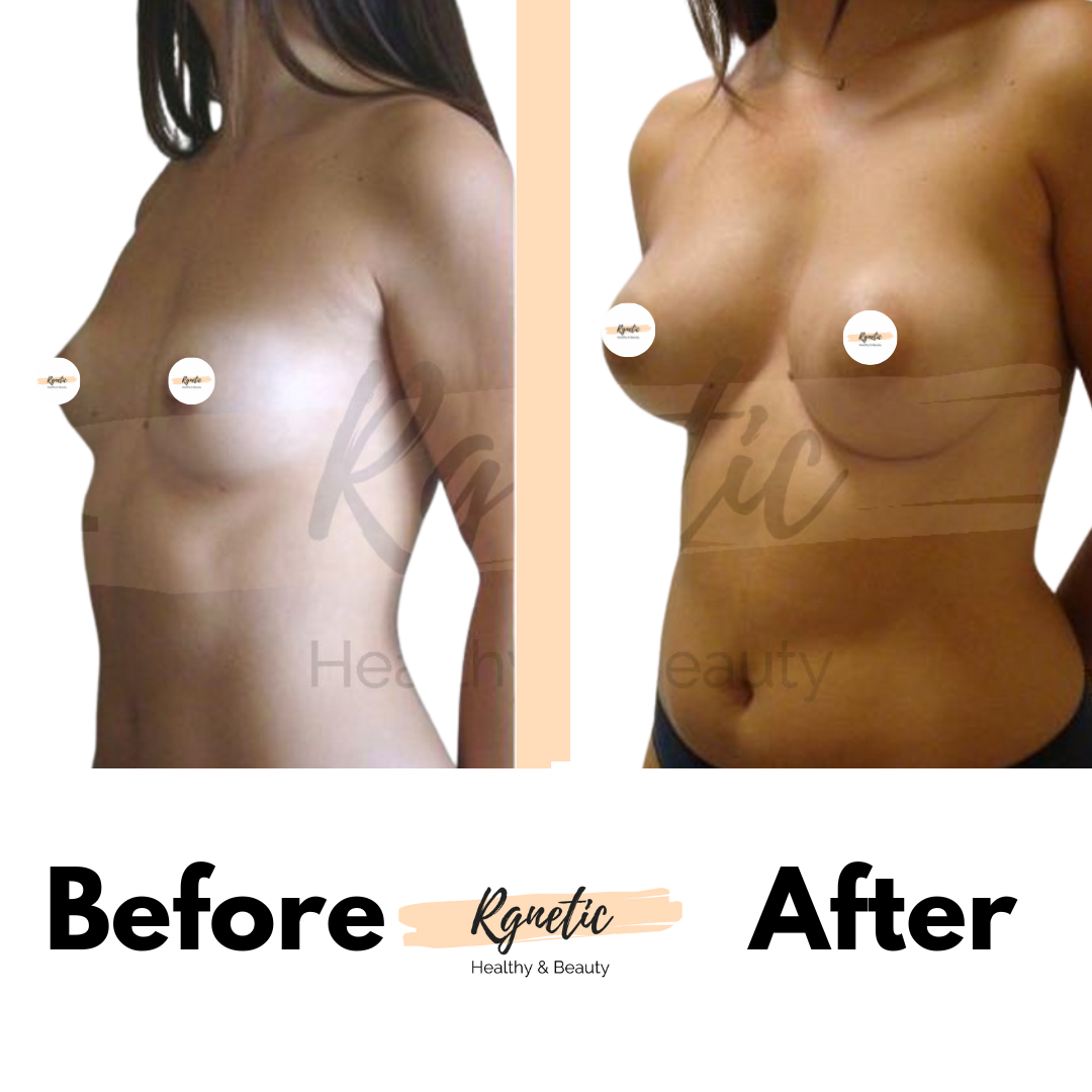 Breast lift
