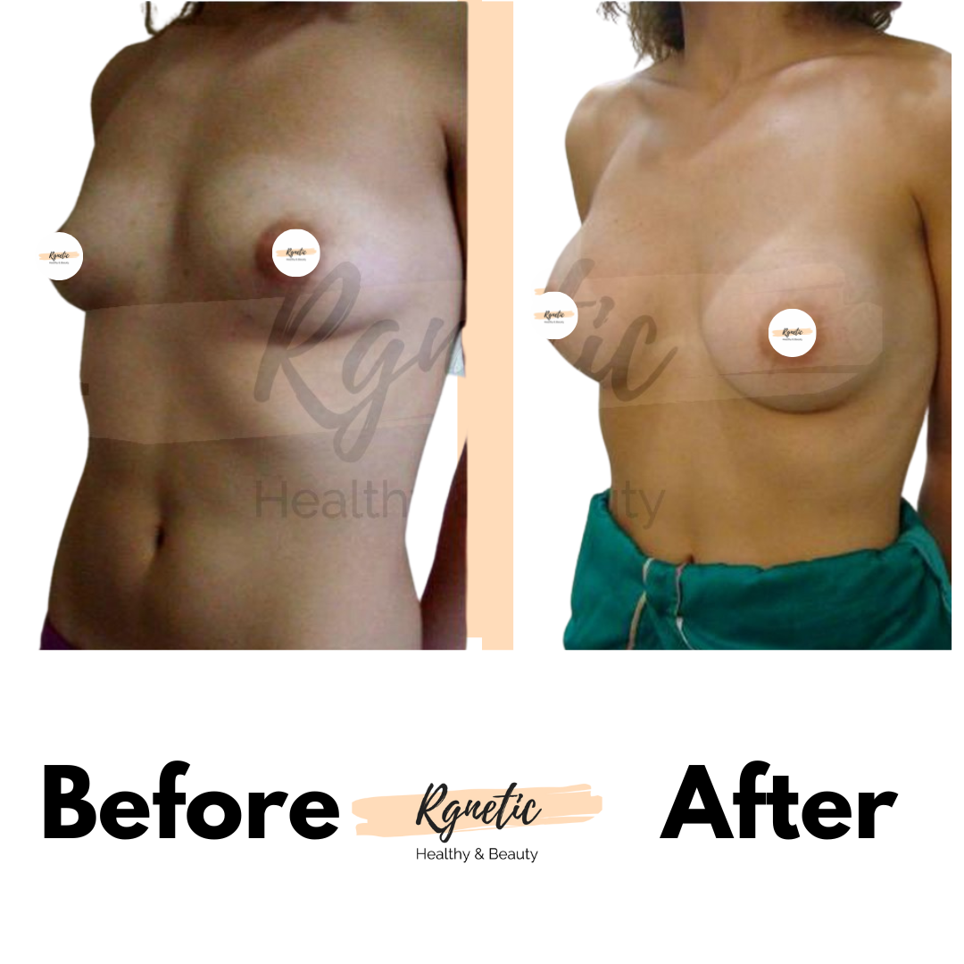 Breast lift