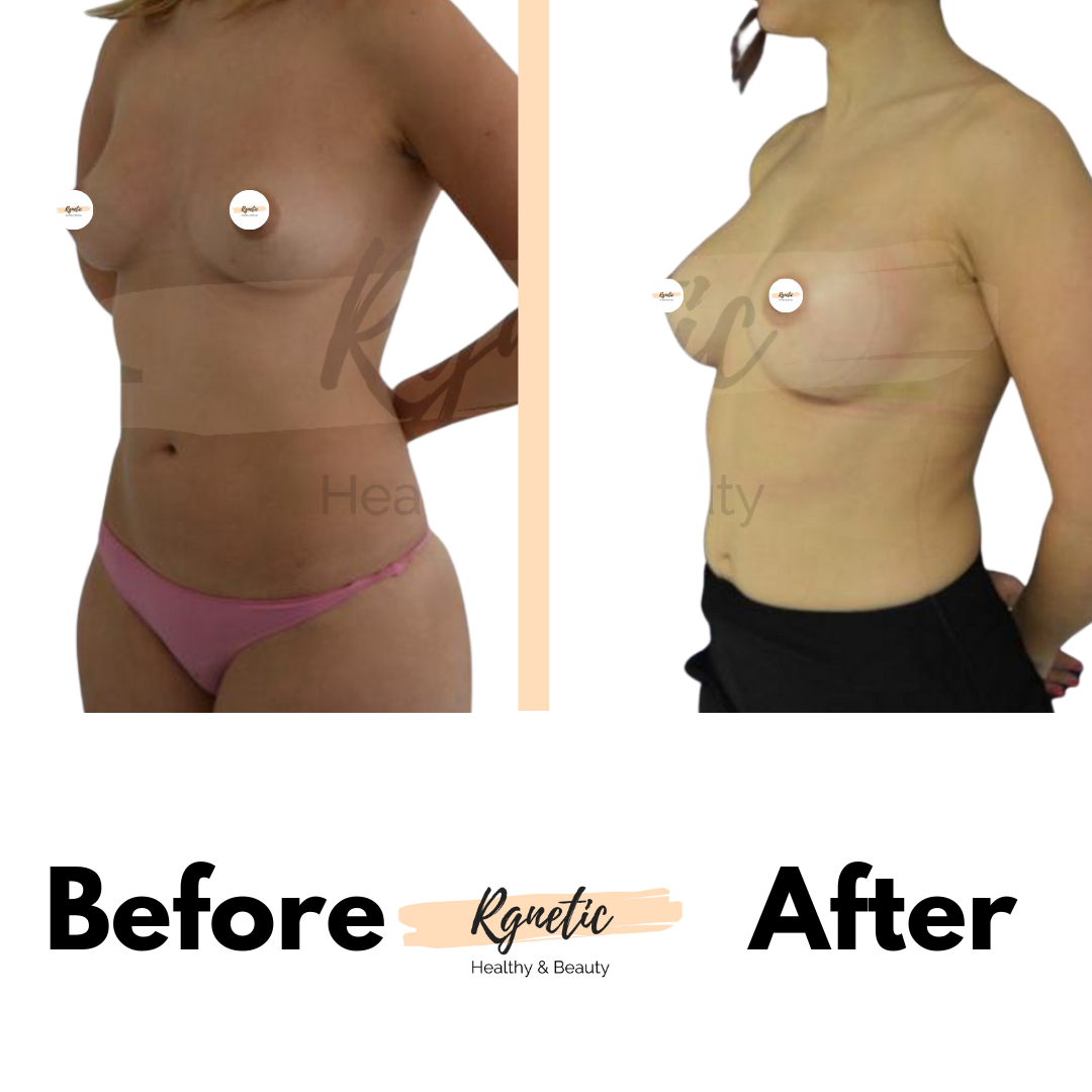 Breast lift