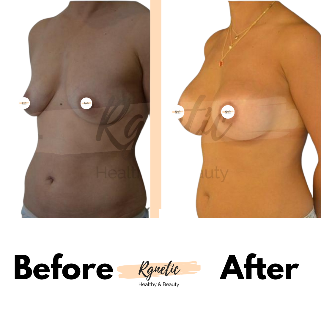 Breast lift