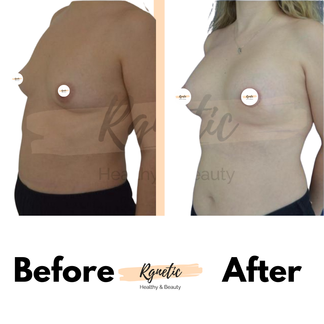Breast lift