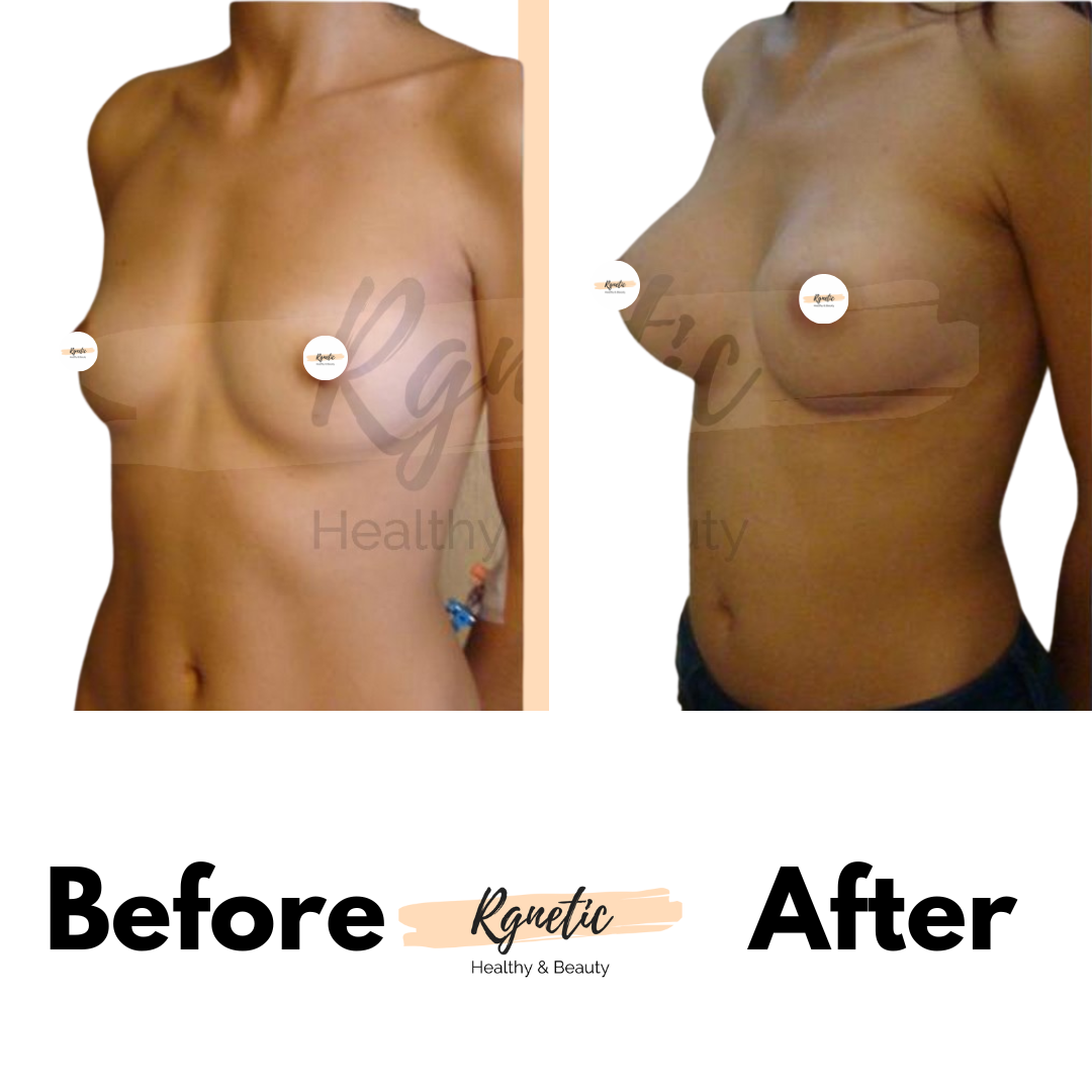 Breast lift