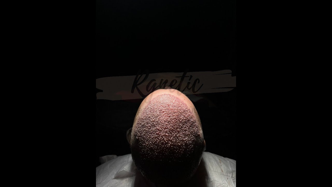 #haartransplantation #haarverlust  #hairloss #haircut #trasplantedecabello #fue #hairtransplant