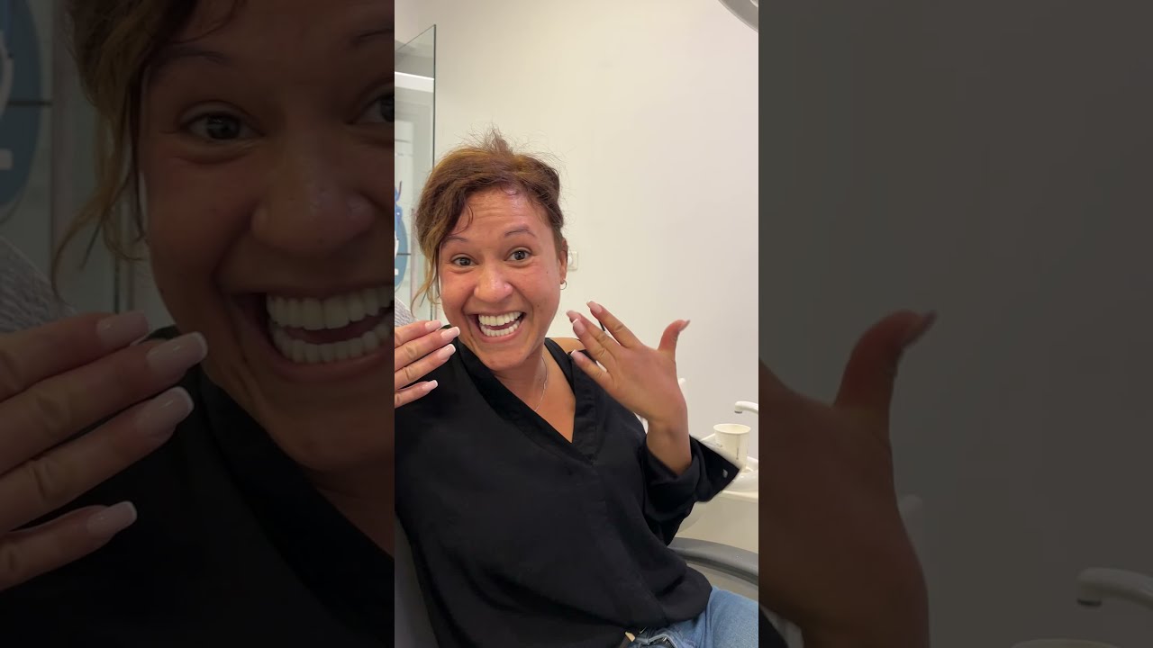 Hollywood Smile Veneers
