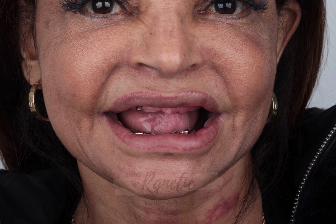 Implants
