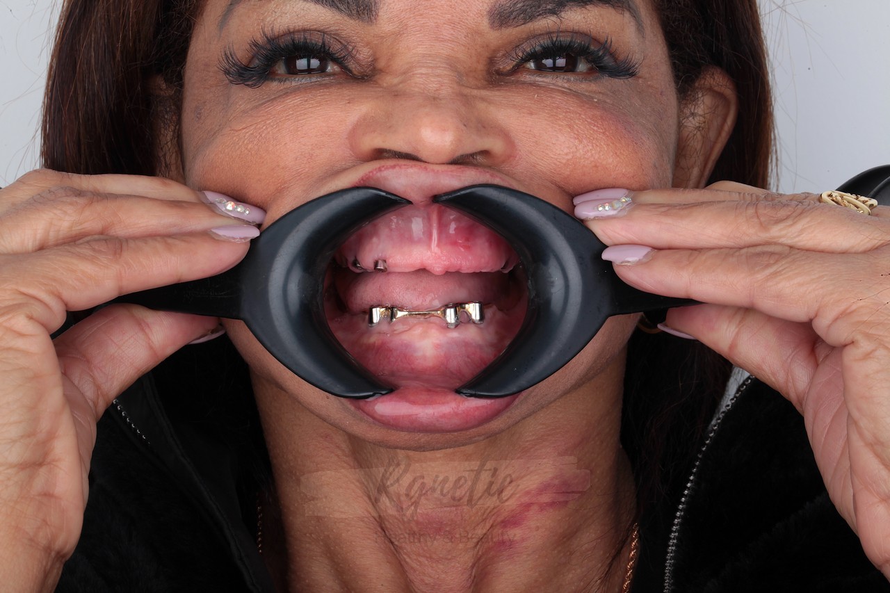 Implants