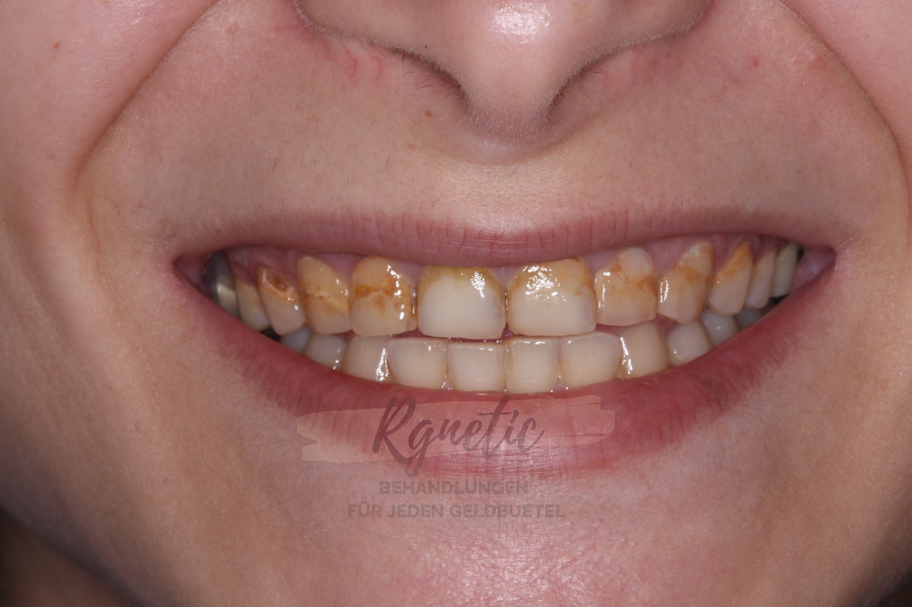 Dental Veneers