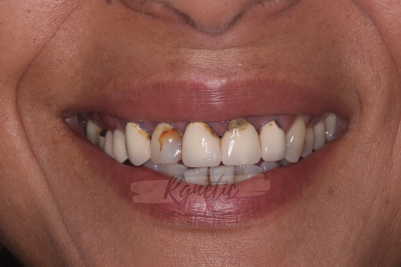 Dental Veneers