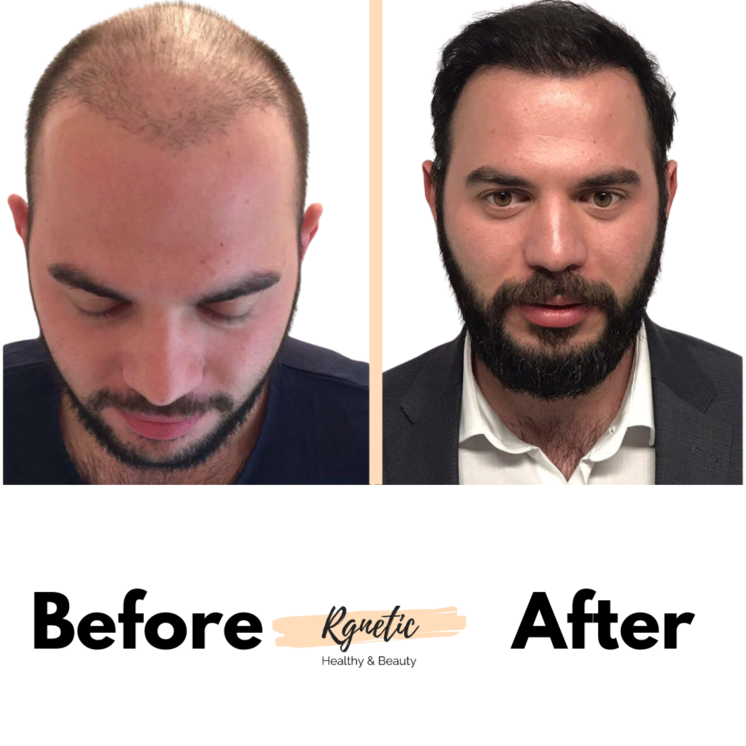 Hair Transplant Before & After