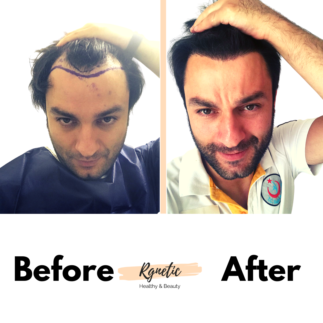 Hair Transplant Before & After