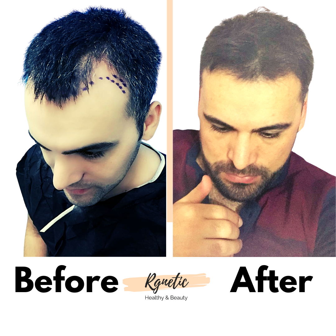 Hair Transplant