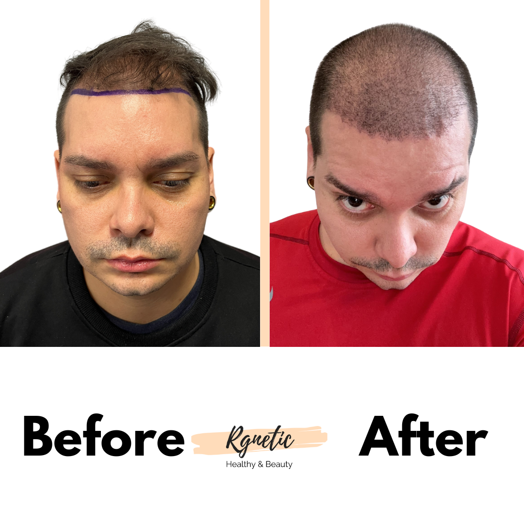 FUE Technique