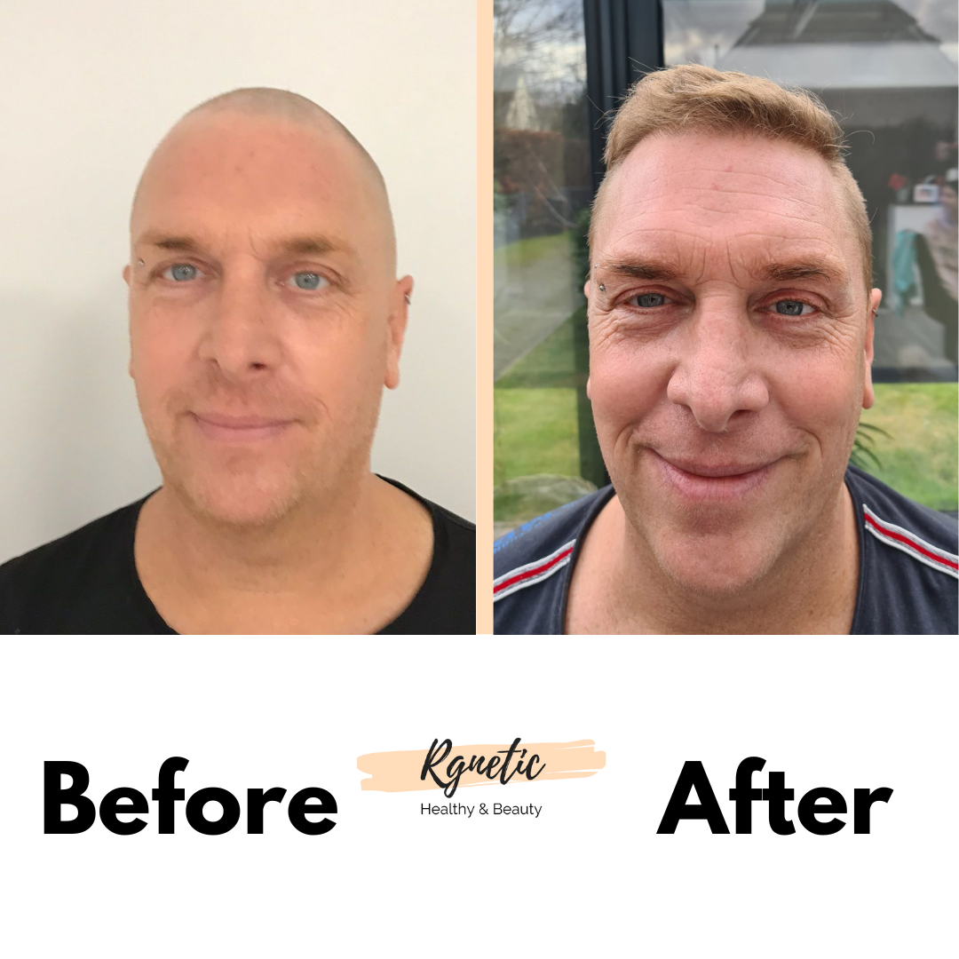 Hair transplant Before & After
