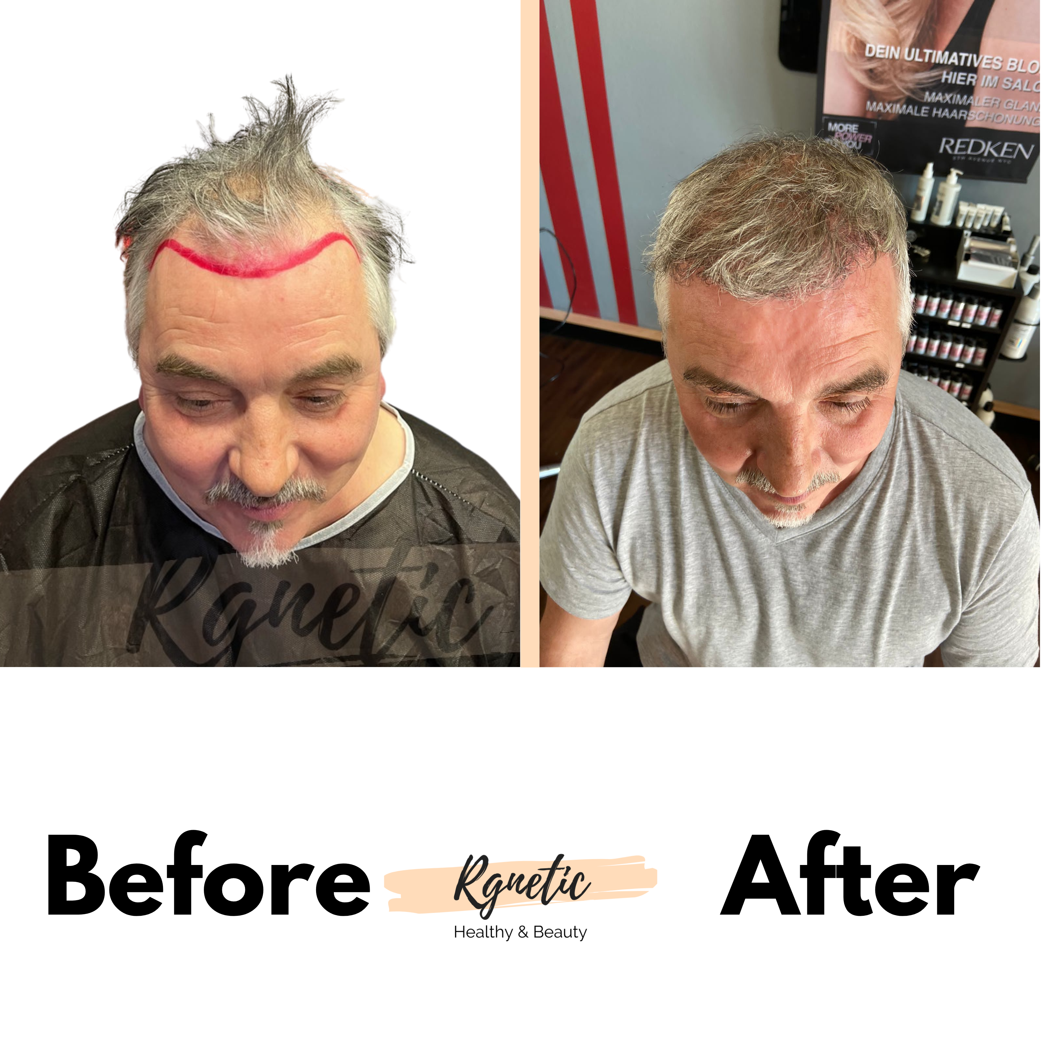 Hair transplant Before & After
