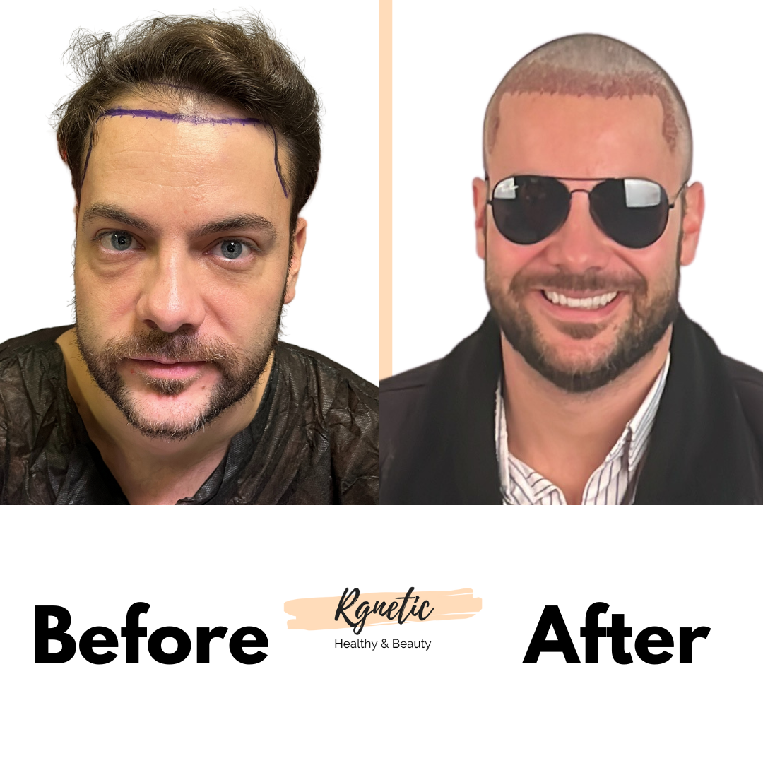 Hair transplant Before & After
