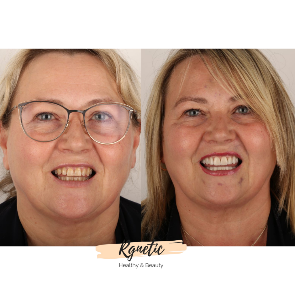 veneers befor & after @rgnetic