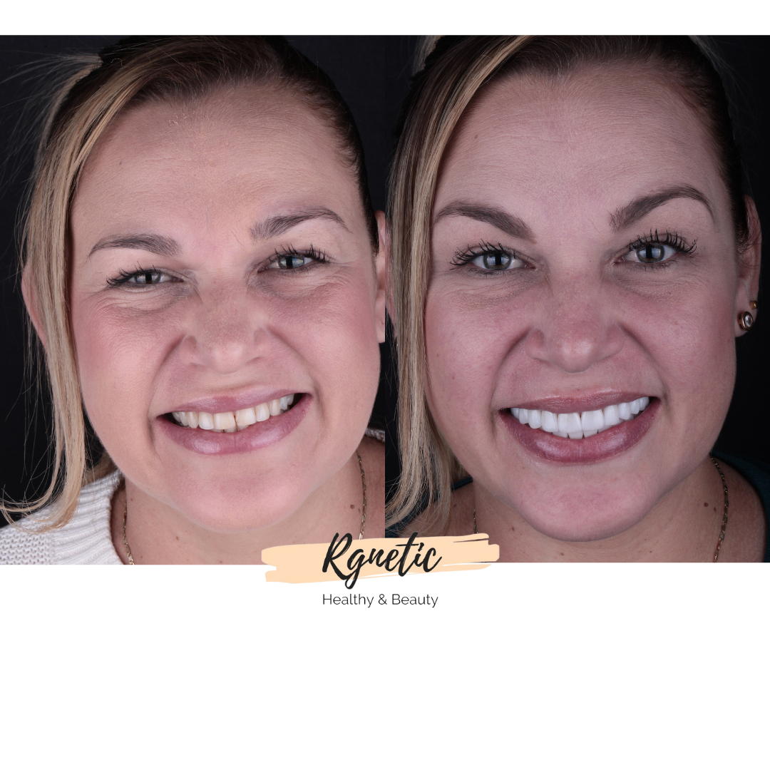 Veneers Lächeln-Makeover