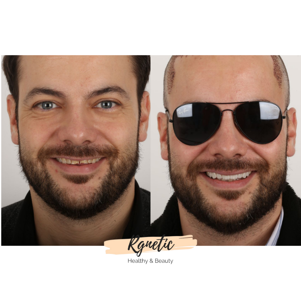 veneers @rgnetic